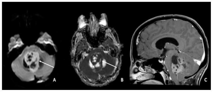 https://cdn.ncbi.nlm.nih.gov/pmc/blobs/f25b/9913305/ee2169c6489e/cancers-15-00618-g004.jpg