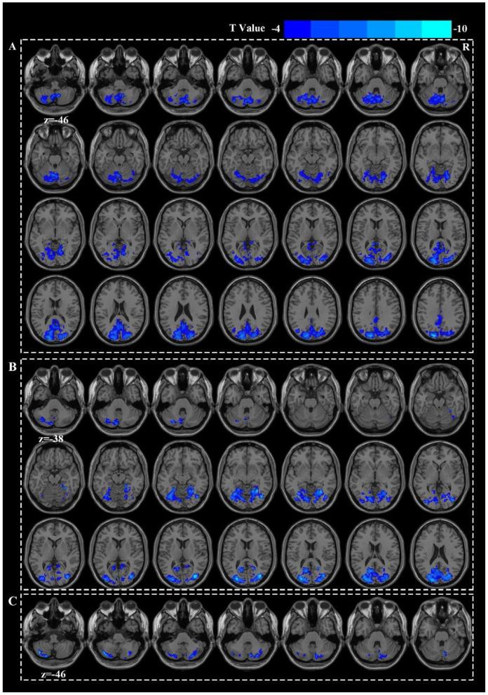 https://cdn.ncbi.nlm.nih.gov/pmc/blobs/f27e/12241811/956ec8c83781/fneur-16-1596306-g0002.jpg