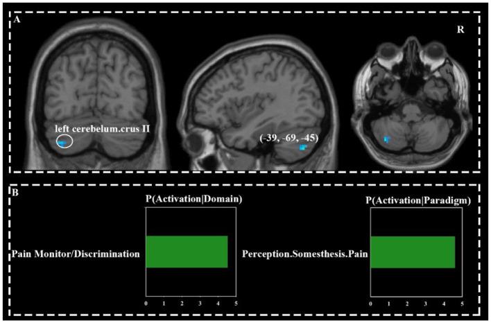 https://cdn.ncbi.nlm.nih.gov/pmc/blobs/f27e/12241811/f9b12fc8dc86/fneur-16-1596306-g0003.jpg