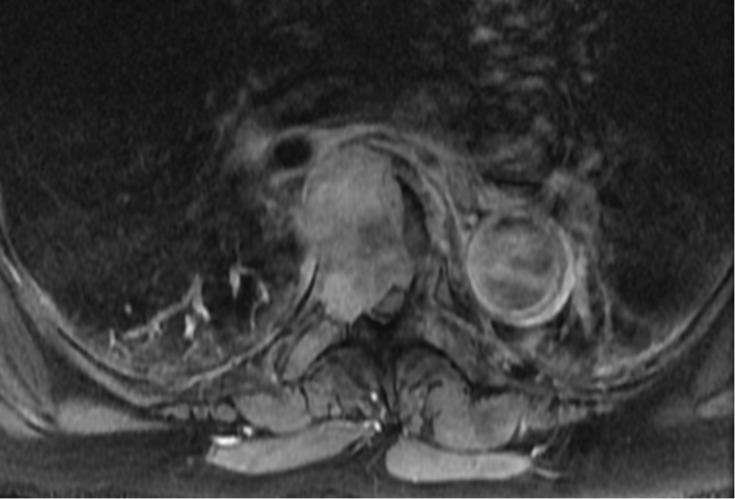 https://cdn.ncbi.nlm.nih.gov/pmc/blobs/f28c/5415380/55316a040e8d/cureus-0009-00000001132-i04.jpg