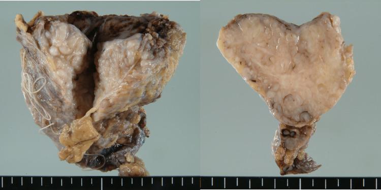https://cdn.ncbi.nlm.nih.gov/pmc/blobs/f2a1/12179750/19c412d641b3/cureus-0017-00000084520-i04.jpg