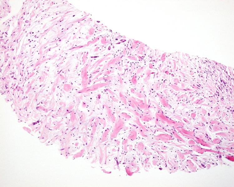https://cdn.ncbi.nlm.nih.gov/pmc/blobs/f2a1/12179750/d037980c2bb4/cureus-0017-00000084520-i03.jpg