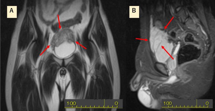https://cdn.ncbi.nlm.nih.gov/pmc/blobs/f2a1/12179750/e54281885ffd/cureus-0017-00000084520-i01.jpg