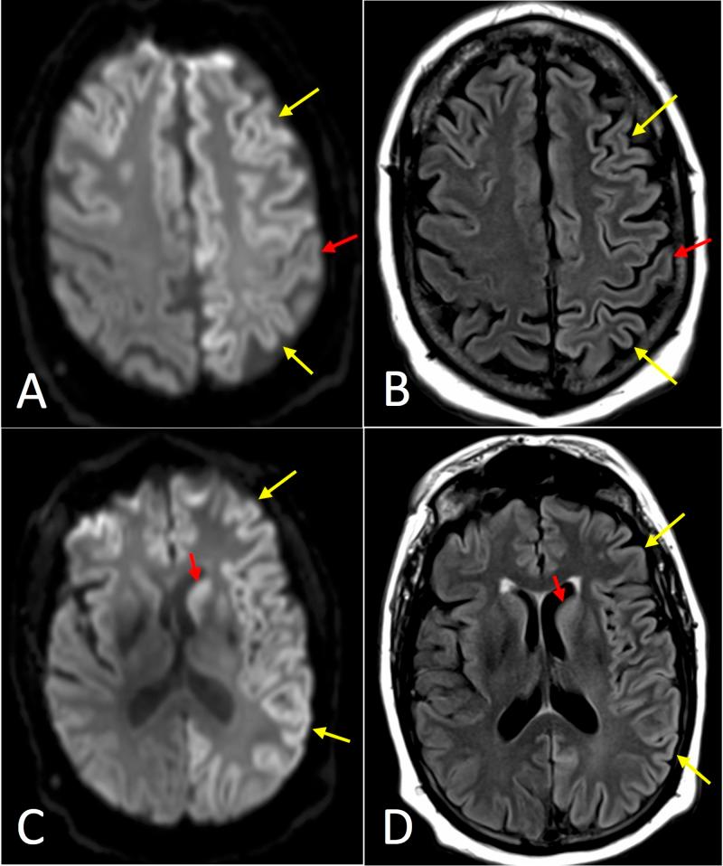 https://cdn.ncbi.nlm.nih.gov/pmc/blobs/f2be/6384041/030471adedfd/cureus-0010-00000003725-i05.jpg