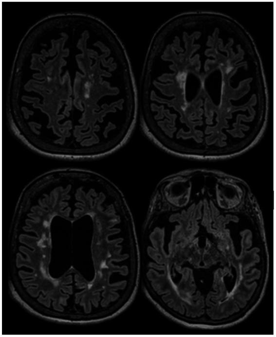 https://cdn.ncbi.nlm.nih.gov/pmc/blobs/f2d4/10361071/e3fab92d611e/fneur-14-1197212-g003.jpg