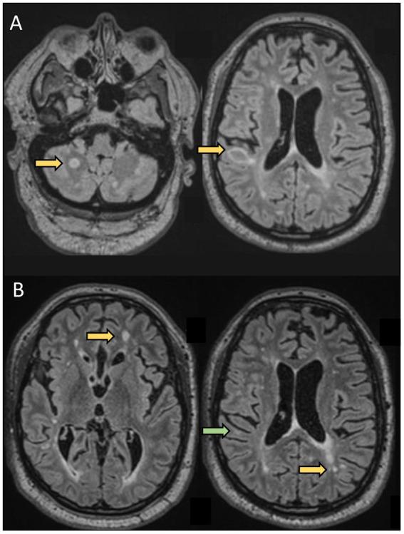 https://cdn.ncbi.nlm.nih.gov/pmc/blobs/f2d4/10361071/e7d8055598e7/fneur-14-1197212-g002.jpg