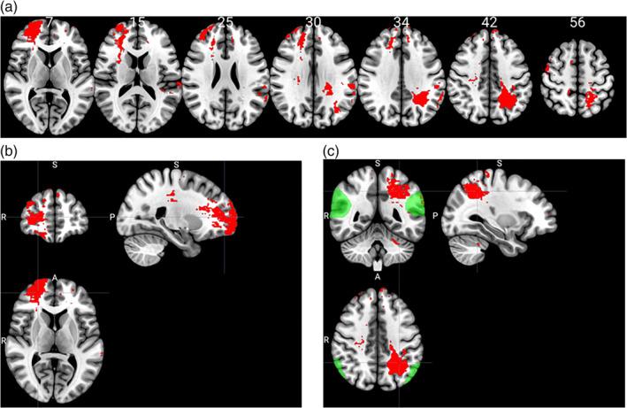 https://cdn.ncbi.nlm.nih.gov/pmc/blobs/f313/7721243/ed3c434b36c7/HBM-42-65-g004.jpg