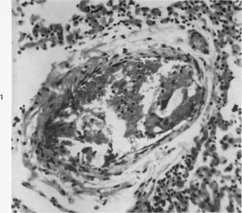 https://cdn.ncbi.nlm.nih.gov/pmc/blobs/f39d/1942825/6a88308ea827/amjpathol00600-0017-a.jpg