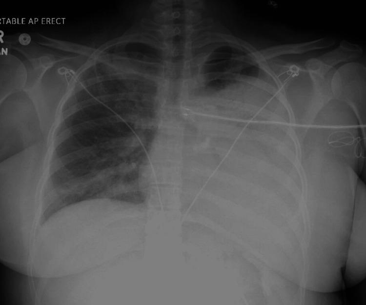 https://cdn.ncbi.nlm.nih.gov/pmc/blobs/f3c2/9370069/119d5bac0f7a/cureus-0014-00000026785-i03.jpg