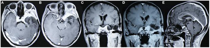 https://cdn.ncbi.nlm.nih.gov/pmc/blobs/f3c3/10060889/694ef9502b5b/fneur-14-1097686-g0004.jpg