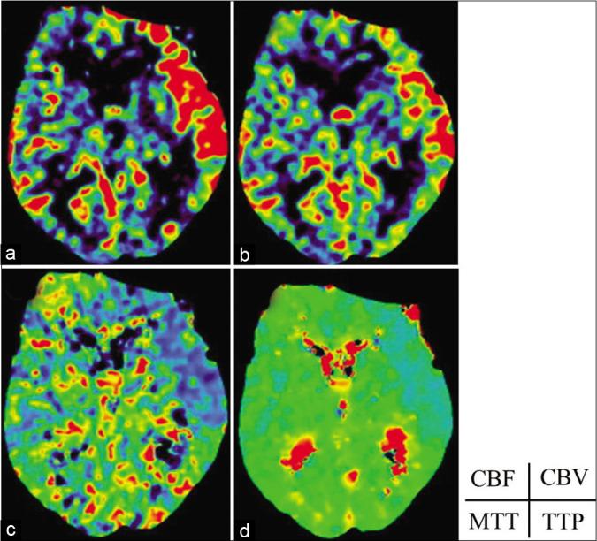 https://cdn.ncbi.nlm.nih.gov/pmc/blobs/f3da/8053470/5d833c2a6cab/SNI-12-124-g002.jpg