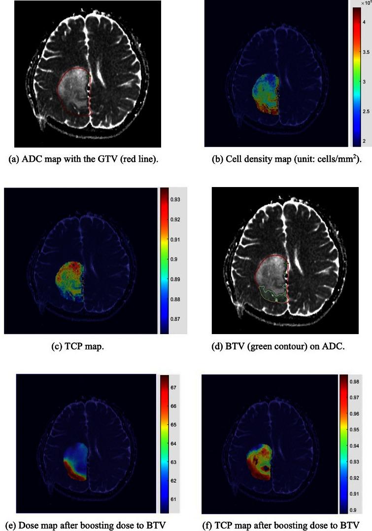https://cdn.ncbi.nlm.nih.gov/pmc/blobs/f3de/10230387/f2ea0ad31e9a/bjr.20220384.g003.jpg