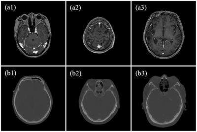 https://cdn.ncbi.nlm.nih.gov/pmc/blobs/f3de/9680583/fefdeb33a882/ACM2-23-e13775-g003.jpg