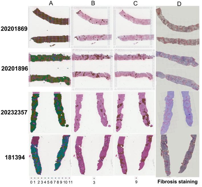 https://cdn.ncbi.nlm.nih.gov/pmc/blobs/f3df/11891380/4c4ad35dcf1b/LIV-45-0-g002.jpg