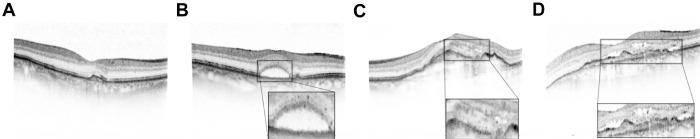 https://cdn.ncbi.nlm.nih.gov/pmc/blobs/f425/10103736/22c3b1297d13/tvst-12-4-12-f001.jpg