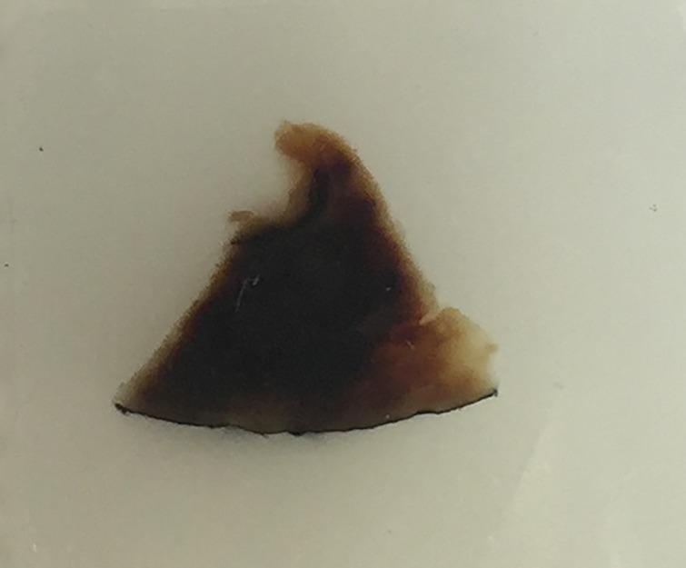 https://cdn.ncbi.nlm.nih.gov/pmc/blobs/f42e/4738194/e1f1bf0ff8bd/edmcr-2016-150117-g003.jpg