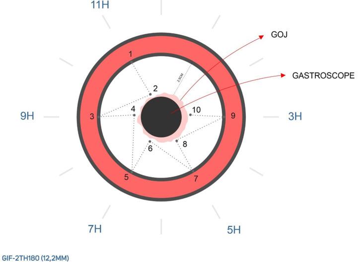 https://cdn.ncbi.nlm.nih.gov/pmc/blobs/f431/11514428/229bd29c81e6/WJGE-16-557-g001.jpg
