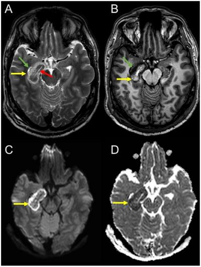 https://cdn.ncbi.nlm.nih.gov/pmc/blobs/f445/11977048/9fa184d9e009/JON-35-0-g001.jpg