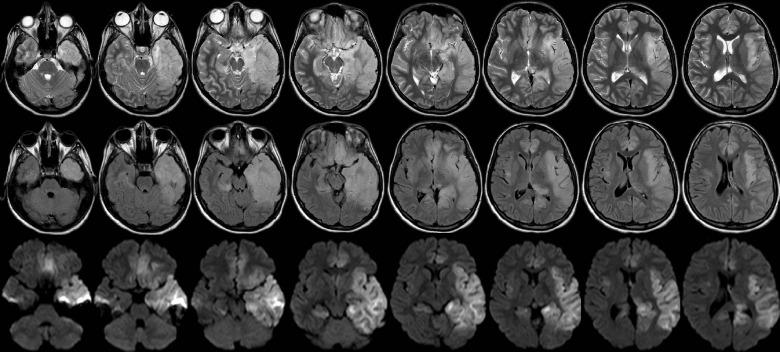 https://cdn.ncbi.nlm.nih.gov/pmc/blobs/f474/11237186/46931cf4b536/encephalitis-2024-00031f1.jpg