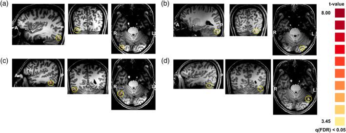 https://cdn.ncbi.nlm.nih.gov/pmc/blobs/f47f/7268038/f78c37f124ee/HBM-41-1754-g004.jpg