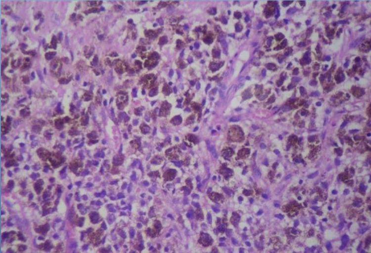 https://cdn.ncbi.nlm.nih.gov/pmc/blobs/f506/8259073/2bbeaf213a46/cureus-0013-00000015474-i02.jpg
