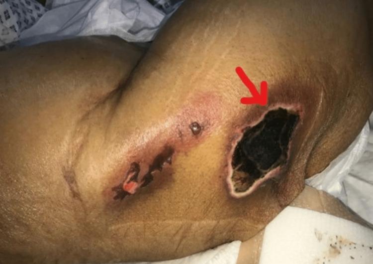 https://cdn.ncbi.nlm.nih.gov/pmc/blobs/f509/10344639/4aebf1af56e1/cureus-0015-00000040384-i01.jpg
