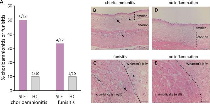 https://cdn.ncbi.nlm.nih.gov/pmc/blobs/f50f/7942245/5c5f4b9ae365/lupus-2020-000463f05.jpg