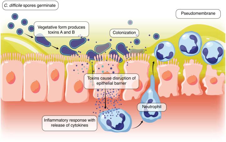 https://cdn.ncbi.nlm.nih.gov/pmc/blobs/f534/9679343/e73951b211af/10.1177_17562848221134396-fig3.jpg