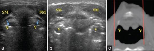 https://cdn.ncbi.nlm.nih.gov/pmc/blobs/f535/5516492/d0439159a1ce/SJA-11-299-g006.jpg