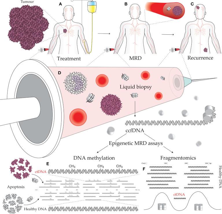 https://cdn.ncbi.nlm.nih.gov/pmc/blobs/f53c/10110851/6399bca68eec/fonc-13-1103797-g001.jpg