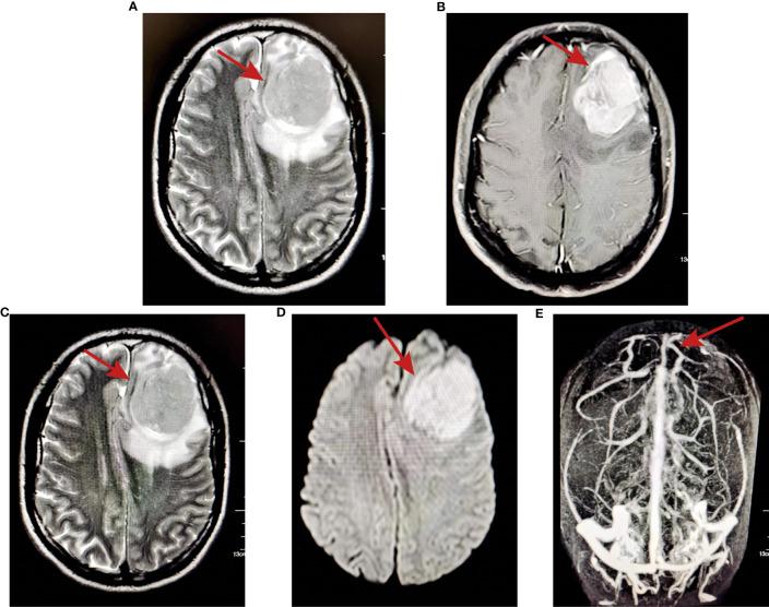 https://cdn.ncbi.nlm.nih.gov/pmc/blobs/f5c5/10370419/fecae8b81305/fonc-13-1209244-g002.jpg