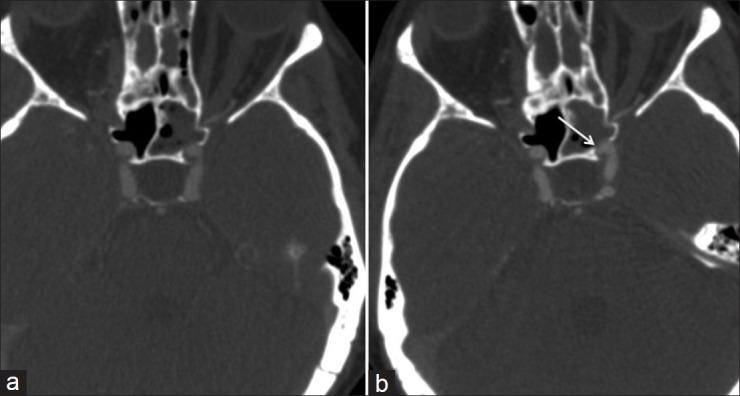 https://cdn.ncbi.nlm.nih.gov/pmc/blobs/f60e/3551517/3cc65aaf5a7c/SNI-3-160-g001.jpg