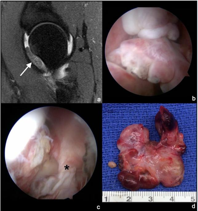 https://cdn.ncbi.nlm.nih.gov/pmc/blobs/f635/5582699/2aefab1ceb99/10.1177_1941738117712675-fig4.jpg