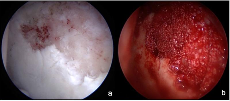 https://cdn.ncbi.nlm.nih.gov/pmc/blobs/f635/5582699/a5081a1bf32c/10.1177_1941738117712675-fig2.jpg