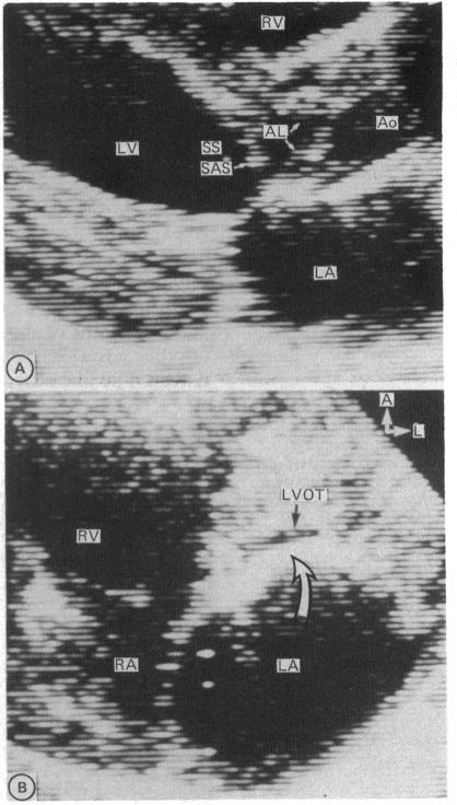 https://cdn.ncbi.nlm.nih.gov/pmc/blobs/f64c/1024631/1cf3e209db18/brheartj00041-0047-a.jpg