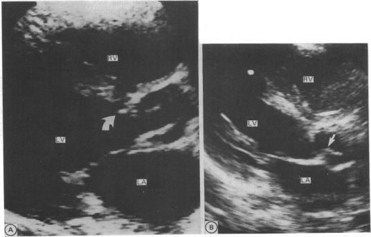 https://cdn.ncbi.nlm.nih.gov/pmc/blobs/f64c/1024631/b5b66c186172/brheartj00041-0048-b.jpg