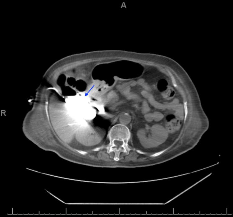 https://cdn.ncbi.nlm.nih.gov/pmc/blobs/f691/8733902/d73df69ec393/cureus-0014-00000020981-i02.jpg
