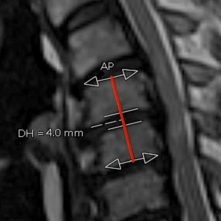 https://cdn.ncbi.nlm.nih.gov/pmc/blobs/f6a1/10188236/0a2490239aff/cureus-0015-00000038864-i02.jpg