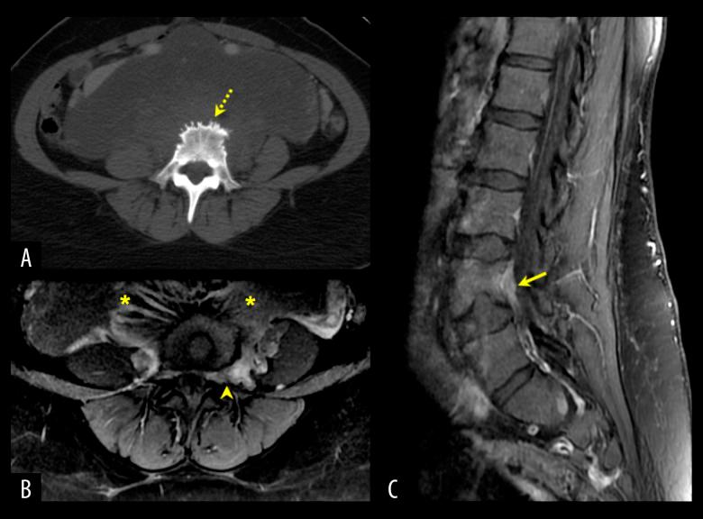 https://cdn.ncbi.nlm.nih.gov/pmc/blobs/f6a5/8235676/ac191dc278aa/amjcaserep-22-e931725-g002.jpg