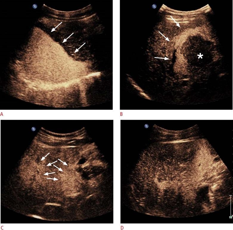 https://cdn.ncbi.nlm.nih.gov/pmc/blobs/f6ab/6920615/9d5a61b4d8f2/usg-19020f4.jpg