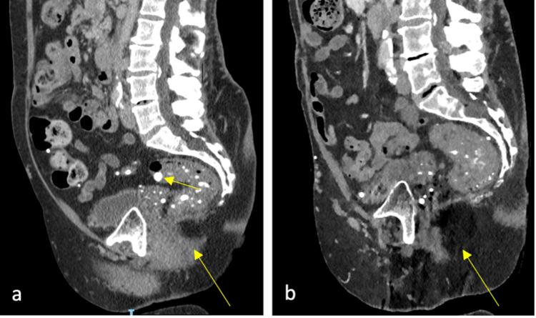 https://cdn.ncbi.nlm.nih.gov/pmc/blobs/f6bb/10270431/41ea4c0a05df/cureus-0015-00000039095-i04.jpg