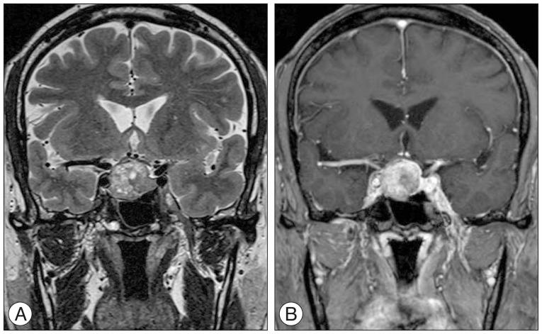 https://cdn.ncbi.nlm.nih.gov/pmc/blobs/f6f7/5106356/a27fa3fbe1d9/jkns-59-577-g002.jpg