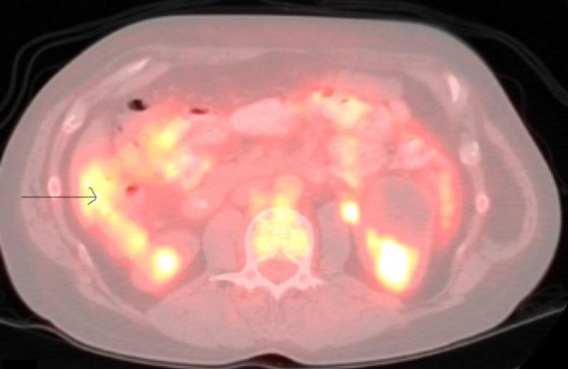 https://cdn.ncbi.nlm.nih.gov/pmc/blobs/f6ff/6516623/0206f26c7f45/cureus-0011-00000004235-i02.jpg