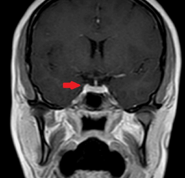 https://cdn.ncbi.nlm.nih.gov/pmc/blobs/f757/11166012/eb1d43cd6b10/cureus-0016-00000060135-i02.jpg