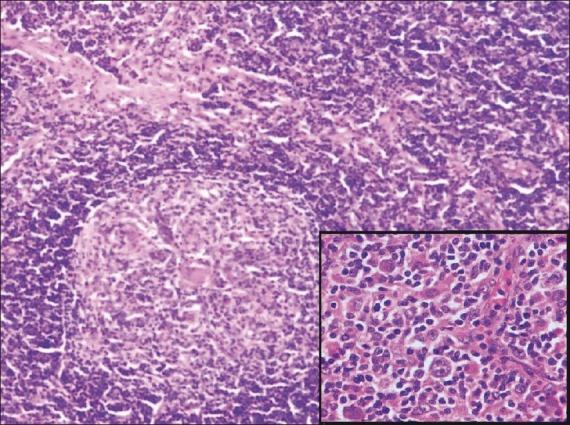 https://cdn.ncbi.nlm.nih.gov/pmc/blobs/f766/3342725/d3c58fcbeb4d/IJMPO-32-162-g001.jpg