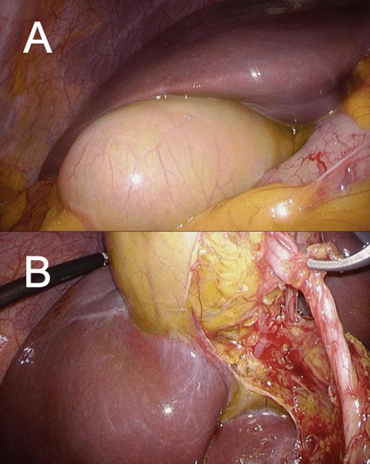 https://cdn.ncbi.nlm.nih.gov/pmc/blobs/f7c9/11717323/9c8dcbb3be49/cureus-0016-00000075444-i04.jpg