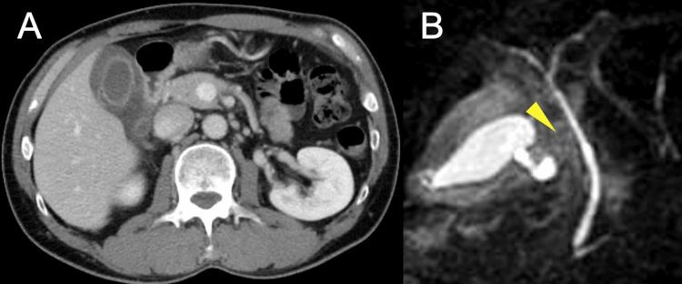 https://cdn.ncbi.nlm.nih.gov/pmc/blobs/f7c9/11717323/cc3bb5b2e366/cureus-0016-00000075444-i03.jpg