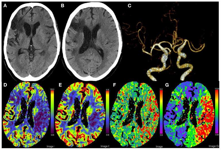 https://cdn.ncbi.nlm.nih.gov/pmc/blobs/f820/9868288/c2566d5a533d/fneur-13-1089255-g0001.jpg