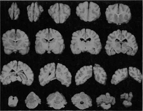 https://cdn.ncbi.nlm.nih.gov/pmc/blobs/f88e/1888895/bc6ff0c83bdd/procrsmed00382-0089-a.jpg