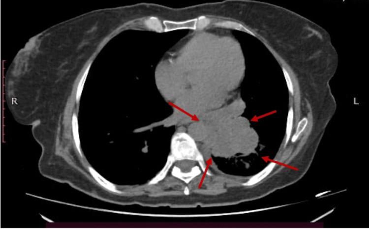 https://cdn.ncbi.nlm.nih.gov/pmc/blobs/f890/9481220/27a10f43d8db/cureus-0014-00000027859-i04.jpg